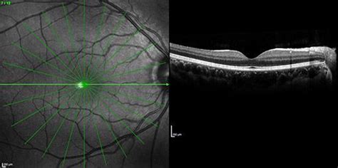 Optical Coherence Tomography Oct Des Plaines Il Libertyville Il Retina Consultants Ltd