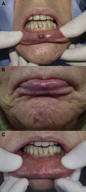 Treatment Of Lip Hemangioma Using Forced Dehydration With Induced