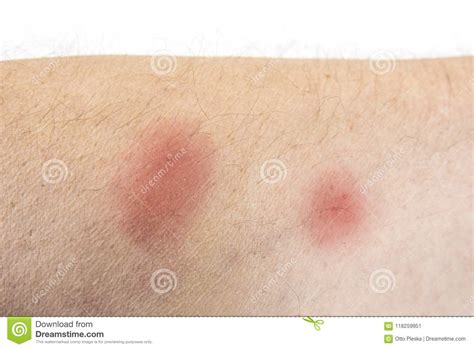 Bites Of Insect On Male Body Bed Bugs Or Flea Stock Image Image Of