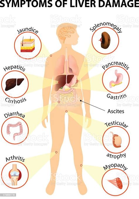 Symptoms Of Liver Disease Stock Illustration Download Image Now Istock