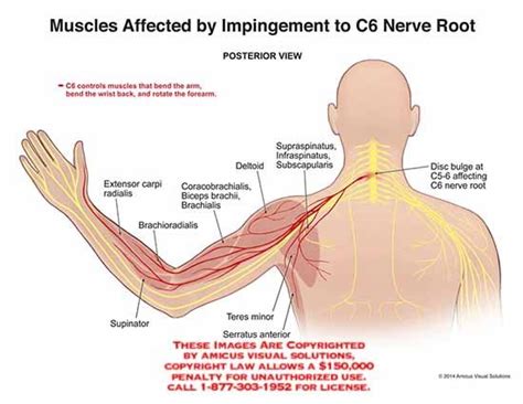 Muscles Affected By Impingement To C6 Nerve Root Massage Therapy