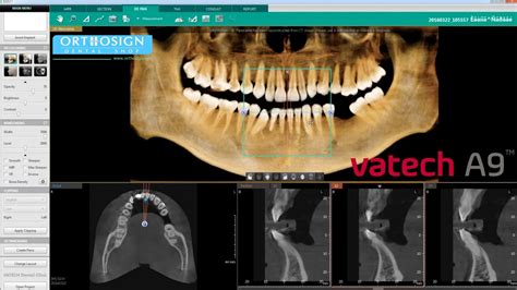 Radiografía Panorámica 3d Cone Beam En Vatech A9 Panorámico Ceph Orthosign Youtube