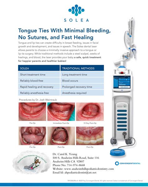 Tongue Ties With Minimal Bleeding No Sutures And Fast Healing Solea