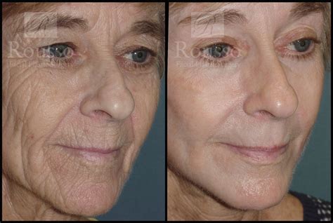Patient 2126626 Chemical Peel Before And After Rousso Adams Facial Plastic Surgery