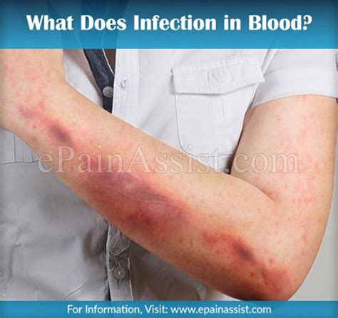 What Does Infection In Blood Or Sepsis Mean And How Is It Treated