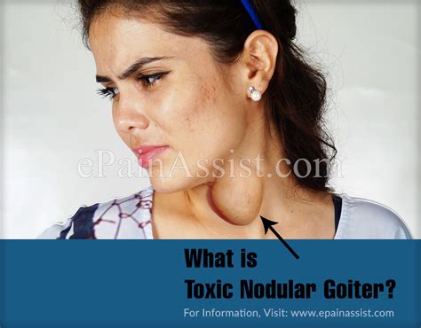 Toxic Nodular Goiter Or Plummer Diseasecausessymptomstreatment