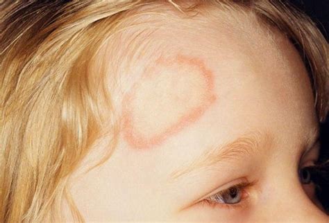 What Causes Ringworm What Causes This