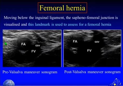 Ultrasound Imaging Of Hernia Parts Of A Youtube Video Tom