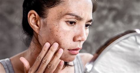 Pitted Acne Scars How They Happen And How To Get Rid Of Them