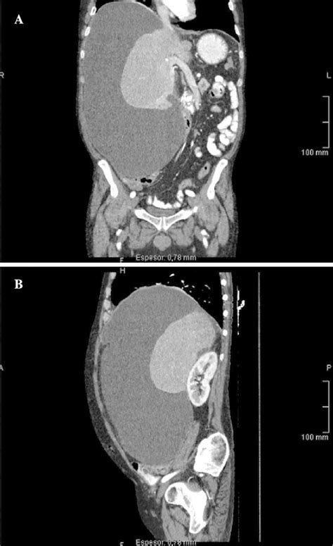 Abdominal Computed Tomography Scan Showing A Large Subhepatic And