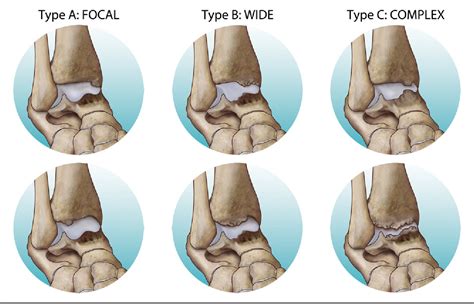 Figure 4 From Arthroscopic Treatment Of Ankle Anterior Bony Impingement