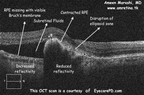 Rpe Tear And Its Oct Features In A Nutshell