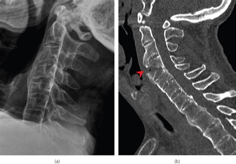 Cervical Spine Radiology Key