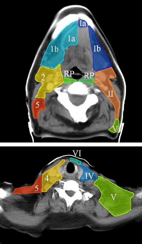 Ct Based Delineation Of Lymph Node Levels And Related Ctvs In The Node