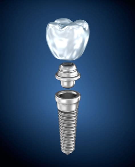 Single Dental Implant Plano Tx Tooth Implant Dallas