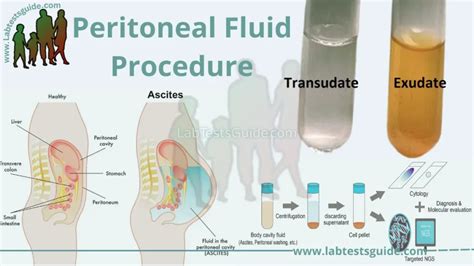 Peritoneal Fluid Test Procedure What You Need To Know