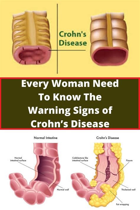 Every Woman Need To Know The Warning Signs Of Crohns Disease Crohns