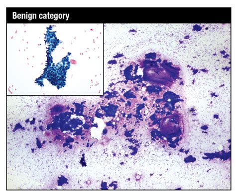 Cytopathology In Focus Standardized Reporting For Breast Fnab Cytology