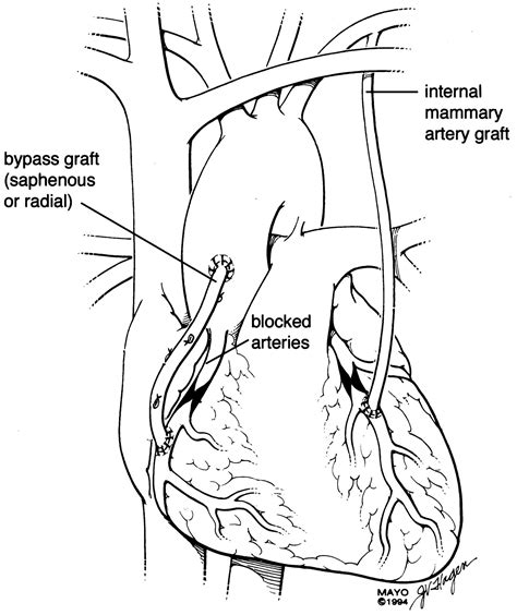 Coronary Artery Bypass Surgery Circulation