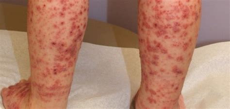 Is There Any Cure For Itp Idiopathic Thrombocytopenic Purpura