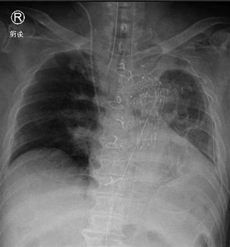 Postoperative Chest Radiography Showing An Endovascular Stent Graft
