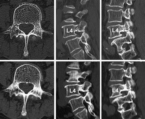 First Lumbar Ct Scans At The Level Of L4 Showing Bilateral Pedicle
