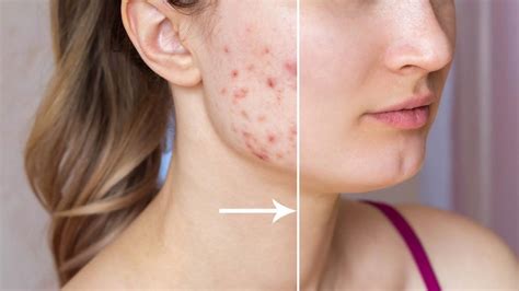 How To Get Rid Of Bothersome Acne Scars Best Impression Med Spa