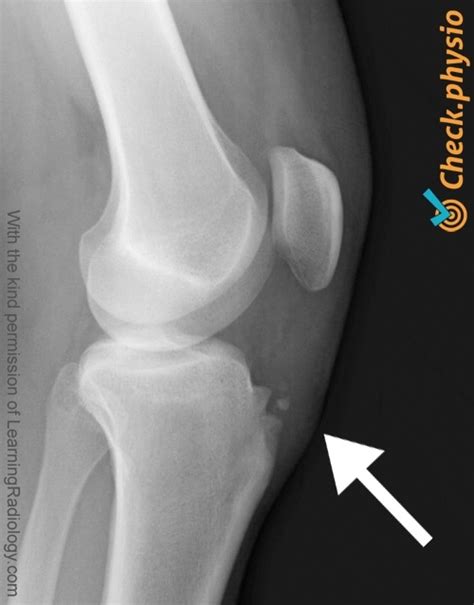 Osgood Schlatter Physio Check