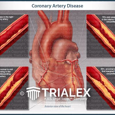 Coronary Artery Disease TrialExhibits Inc