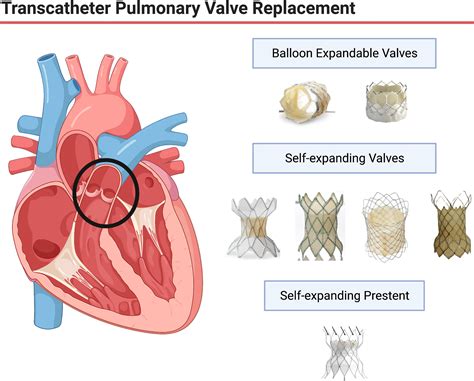 Transcatheter Pulmonary Valve Replacement A Review Of Current Valve