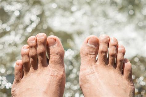 9 Tips For Preventing Athletes Foot This Summer City Podiatry