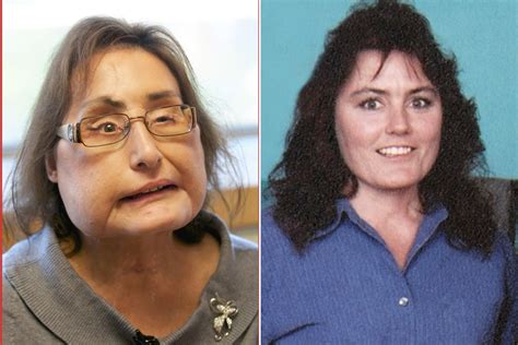 Connie Culp Who Got First Us Face Transplant Dead At 57