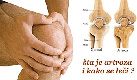 Simptomi i liječenje artroze koljena kuka ramena i stopala