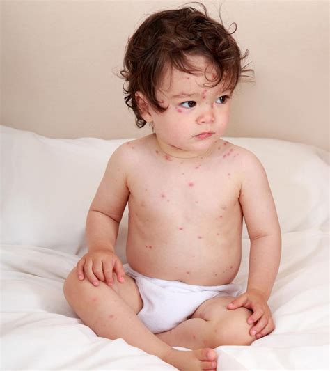 Hives In Toddlers 5 Causes 5 Symptoms And 3 Treatments You Should Be
