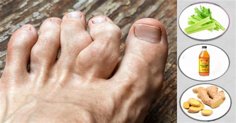 Remedies To Ease Gout Suffering From Home And Prevent Another Flare Up