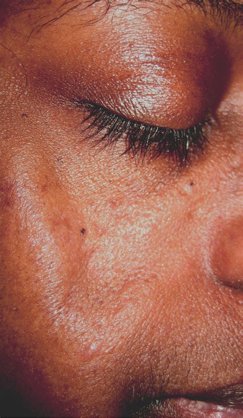 Lupus Erythematosus Panniculitisinduced Facial Atrophy Effective