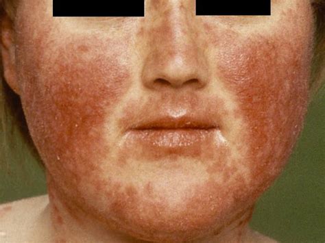 Malar Rash Vlindervormig Erytheem Butterfly Erythema