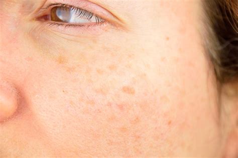 Risk Factors For Skin Cancer Lombardi Institute Of Dermatology Blog