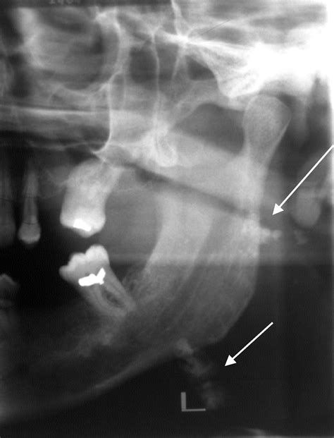 Tonsilloliths Associated With Sialolithiasis In The Submandibular Gland