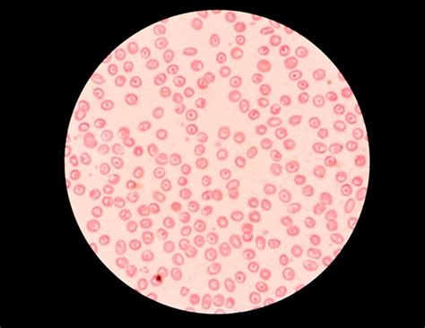 Small Red Blood Cells Could Indicate Cancer