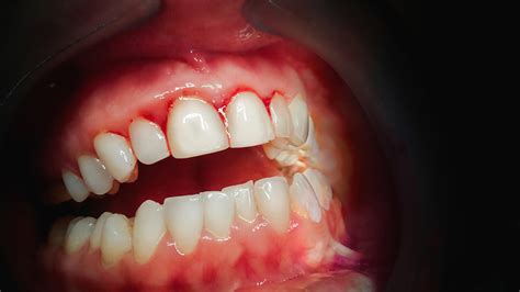 Soft tissue growth over a partially erupted wisdom tooth is called an operculum. Periodontal disease (gum disease) - Butterfly Dental ...