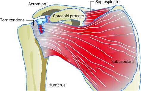 The rotator cuff is made of the tendons of subscapularis, supraspinatus, infraspinatus and teres minor muscle. Diagram Of Shoulder Tendons (With images) | Supraspinatus ...