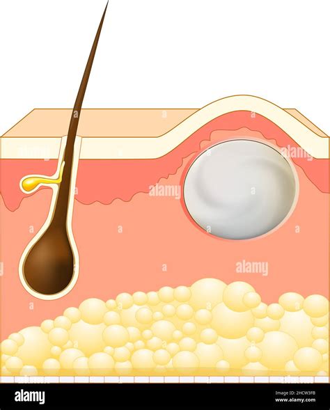 Hair Follicle Cyst Hi Res Stock Photography And Images Alamy