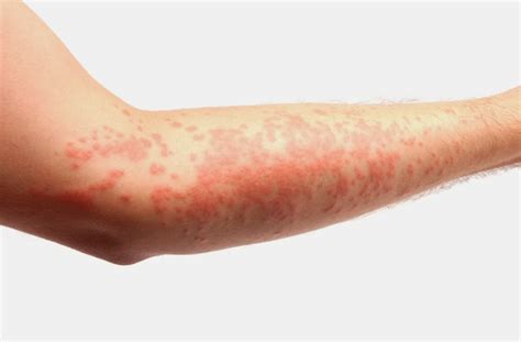 Alergická Kontaktní Dermatitida Příčiny Příznaky A Léčba