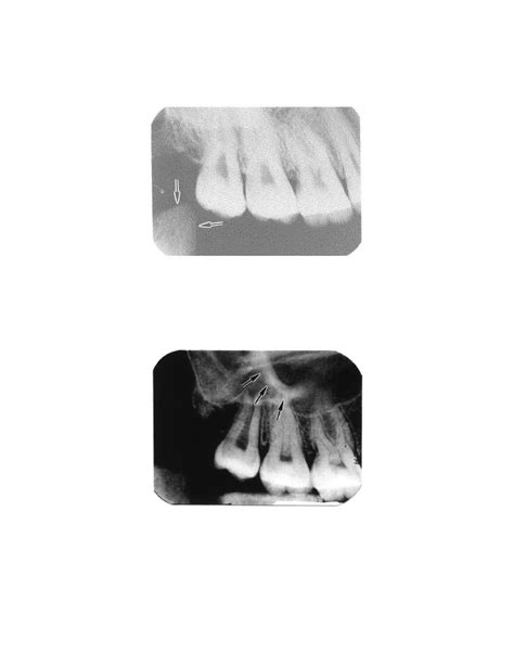 Coronoid Process Of The Mandible Dental Radiography