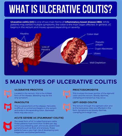 Ulcerative Colitis Is A Relatively Common Long Term Condition That