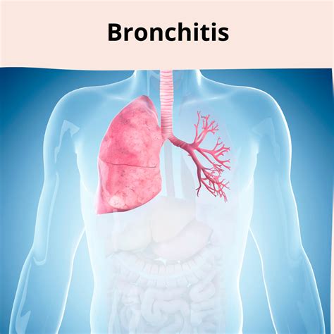 Know About Bronchitis Inflammation Of The Bronchial Tubes