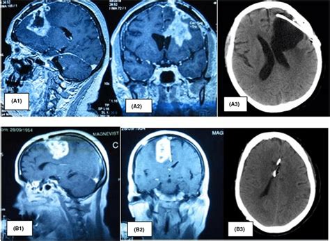 The Removal Of The Recurrent Glioblastoma With The Insertion Of The