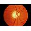 Ophthalmoscope View Of Retina With Optic Atrophy Photograph By Paul 