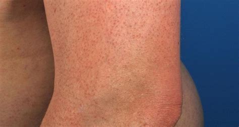 Keratosis Pilaris Archives Academic Dermatology Of Nevada